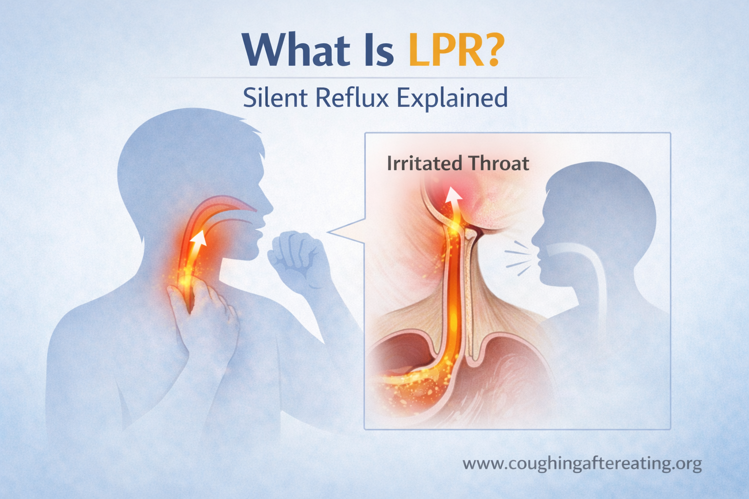 Laryngopharyngeal reflux (LPR) diagram showing stomach acid reaching the throat and causing cough