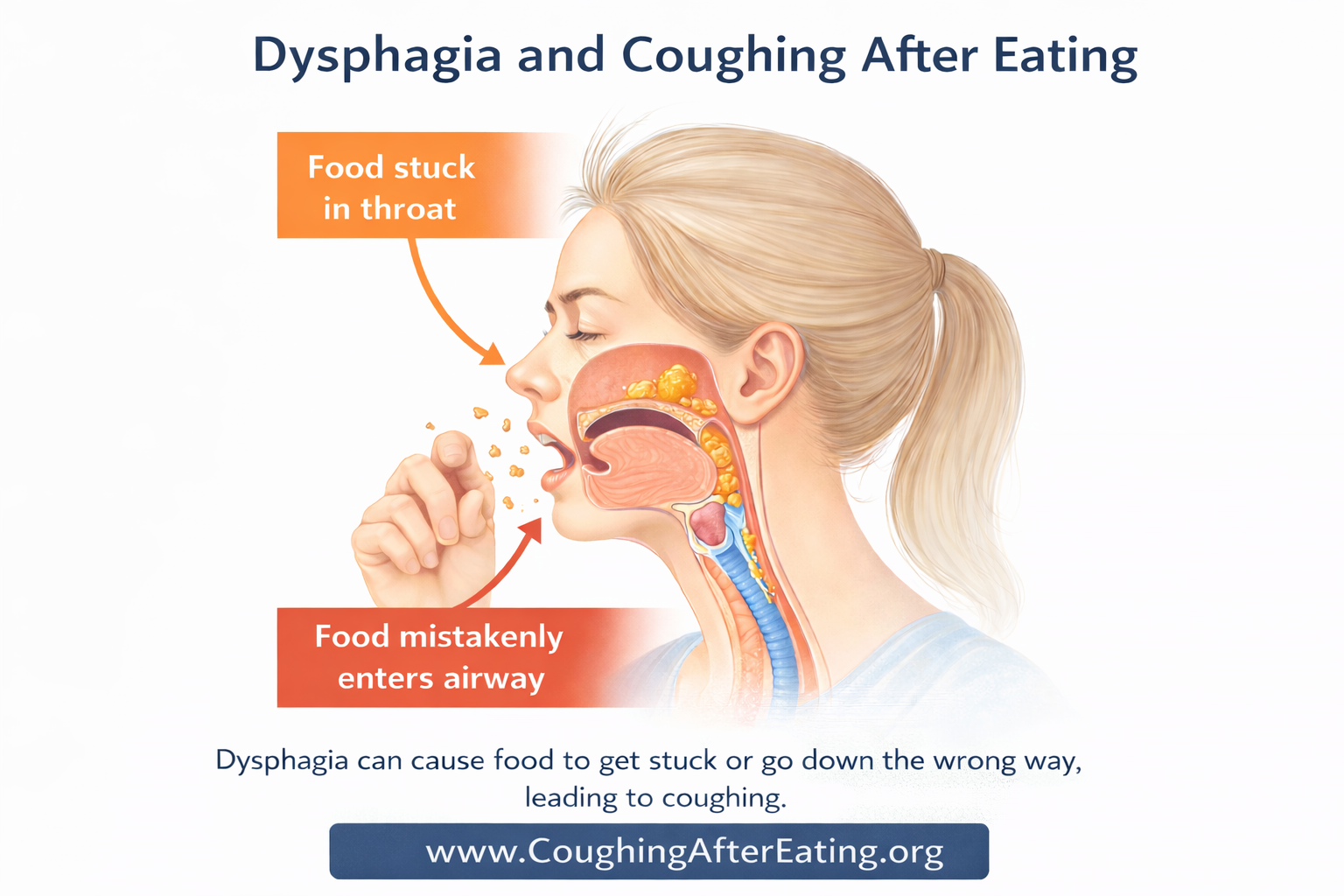 Dysphagia causing coughing after eating when food enters the airway instead of the esophagus